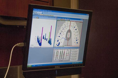 Bite force analysis readouts for a migraine pain sufferer.